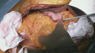 Thoracoabdominal aortic replacement, omentum flap