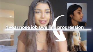 1 year nose job (rhinoplasty) swelling progression - Dr.Resit Burak Kayan