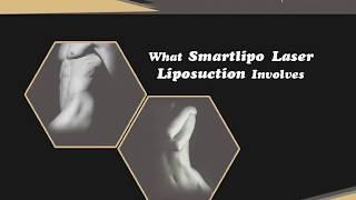 What #Smartlipo #LaserLiposuction Involves