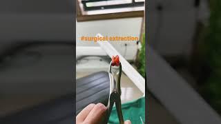 Third molar extraction#surgical extraction#disimpaction#oral surgery#one day#proud