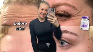 MY FIRST TIME GETTING BOTOX *BEFORE AND AFTER* | sharing my skincare routine