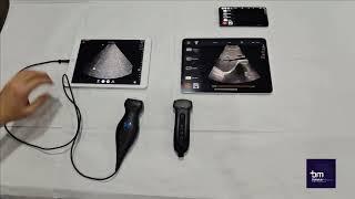 Ballater Medical wireless handheld ultrasound  vs handheld ultrasound with cable - Comparison.