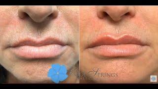 Restylane Refyne Filler to Diminish Lip Lines | Nashville Injector