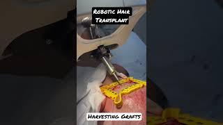 Robotic Hair Transplant using the Artas iX. Now in Orange County. Harvesting grafts