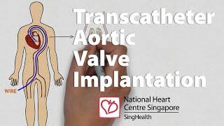 The Revolutionary Treatment for Aortic Stenosis (FULL GUIDE!)