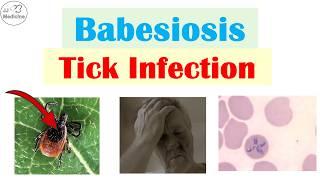 Babesiosis (Infection From Tick Bite) | Pathophysiology, Symptoms, Diagnosis, Treatment