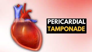 Pericardial Tamponade: Everything You Need To Know