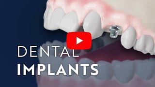 Dental Implants: Restore Function and Preserve Health