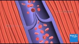 How deep vein thrombosis (DVT) forms | Bupa Health