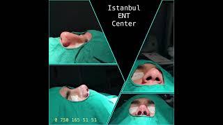 Istanbul ENT Surgeries