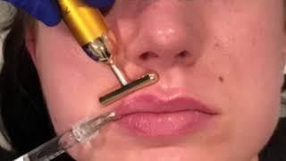 Non Surgical Lip Augmentation by Dr. Kassir