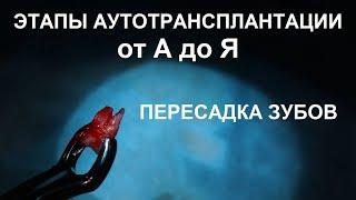 Этапы аутотрансплантации зуба: два удаления, одна припасовка и одна имплантация