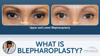 What is Blepharoplasty (Cosmetic Eyelid Surgery)?