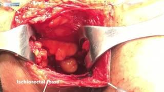 Perianal Approach To Ischiorectal Fossa Tumours