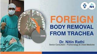 Foreign body || Endodontic Hand File Removal from Trachea ( Airway or Lung) || Dr Nitin Rathi