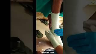 How to do calcaneous fracture cast ...