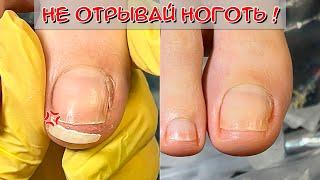 Toenails curl / Nail after a surgeon