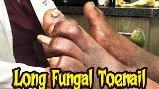 How to Trim Nails Without Hurting Your Patients!