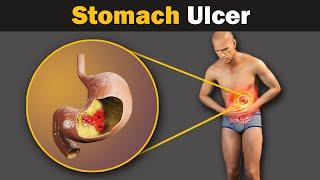 What causes a stomach ulcer? Animation