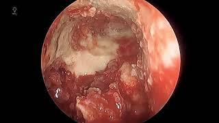 Frontal sinus drill out (Draf III / endoscopic modified lothrop) for severe frontal sinusitis