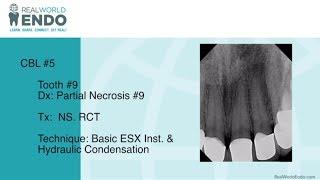 CBL 5 Anterior Tooth ESX Basic Technique