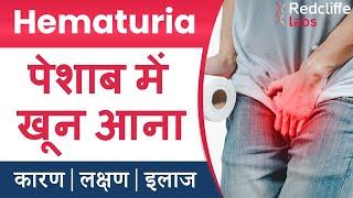 Hematuria (पेशाब में खून आना ) Symptoms And Causes in Hindi |  Hematuria (Blood in Urine) का इलाज