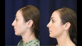 Rhinoplasty Before + After | Nashville Plastic Surgeon