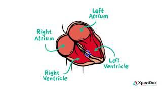 What is Brugada Syndrome and how can it cause sudden heart related death?