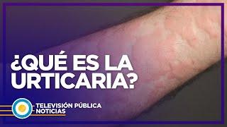 Qué es y cómo tratar la urticaria