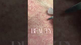 Ingrown Hair Removal