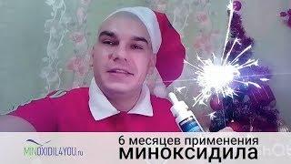 Миноксидил результат применения через 6 месяцев. Отзыв об использовании миноксидила. Minoxidil4you