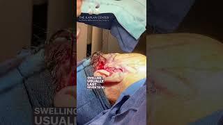 In-Office Short-Scar Facelift : Everything You Need to Know #beauty #antiaging #plasticsurgeon