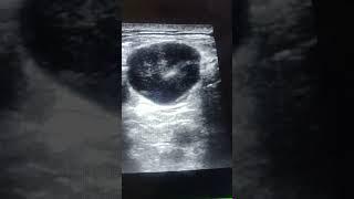 FNAC/fine needle aspiration done by dr shadab nasir
