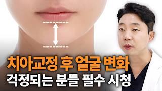 치아교정 후 얼굴변화? 교정후 턱이 길어지는 이유