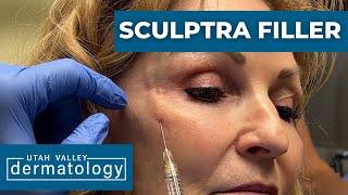 Full Face Restoration With Fillers | Utah Valley Dermatology