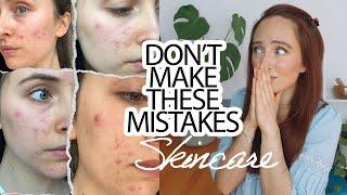 5 COMMON ACNE SKINCARE MISTAKES ‍️ TO STOP NOW!