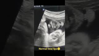 Fetal lips #ultrasound #imaging #learning #medicine #viral #gynecologist #fetus