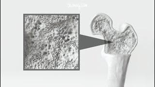 Osteoporosis, an Inevitable Problem for Women