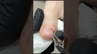 Brace Instead of Surgery? Yes, and It Works!