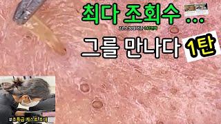 (피지제거)스페셜 게스트 피지 직접 뽑아드렸습니다 _ 피지제거 블랙헤드제거 피지뽑기 _ 약 10개월만에 다시만난 초특급 게스트 그의 피지를 다시한번 박살냈습니다 1탄