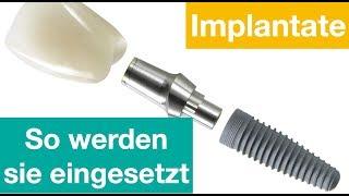 So werden Implantate eingesetzt