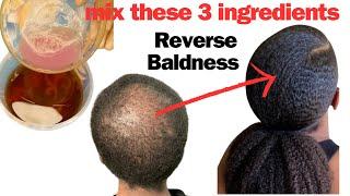 3 Powerful Ingredients For Reversing Baldness in 30 Days. Guaranteed Visible Result in Just One Use