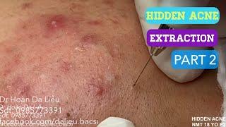 Mụn ẩn đầy mặt|Dermatologist,pimples,whitehead blackhead,anti acne,hidden acne removal 0985773391 p2