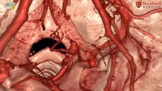 Stanford Neurosurgery Virtual Reality Lab's Anatomy in 3D: PICA Aneurysm