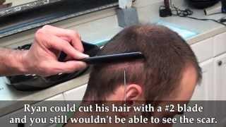 Dr. Brett Bolton Revolutionary Hair Transplant