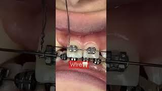 Orthodontic Treatment |Fixed Braces |Ligature,Power Chain |OrthoDentistry