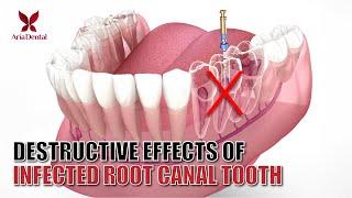 Destructive Effects of Infected Root Canal Tooth | Aria Dental | Maryam Horiyat DDS.