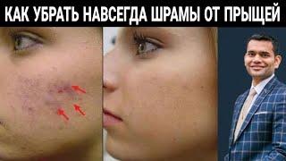 Следы От Прыщей Затягиваются Очень Быстро?