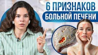 Проблемы с ПЕЧЕНЬЮ на твоей коже! Как понять, что печень НУЖДАЕТСЯ в помощи?