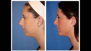Trends in Facial Plastic Surgery | Dr William Portuese | 206-624-6200